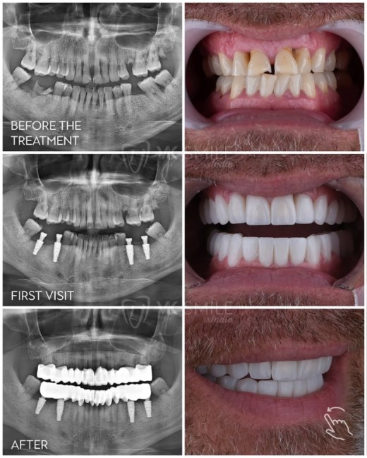 All-on-4-dental-implants-1