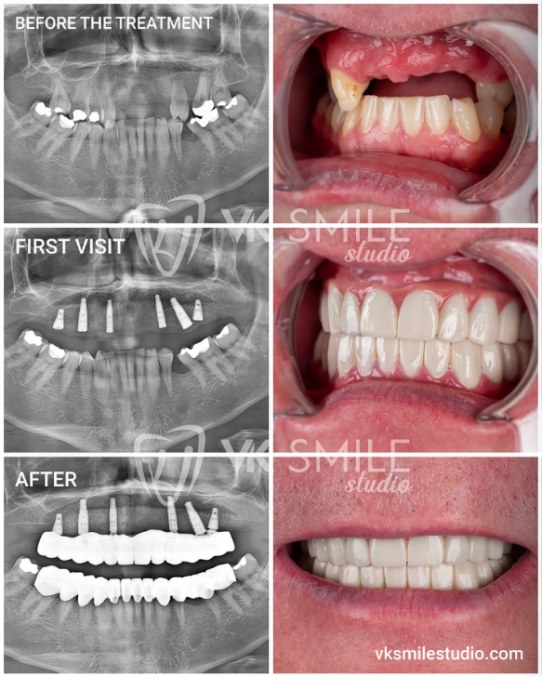 All-on-6-dental-implants-1