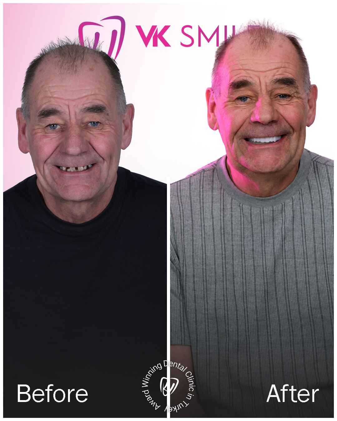 Before-After-VK-Smile-Studio-16