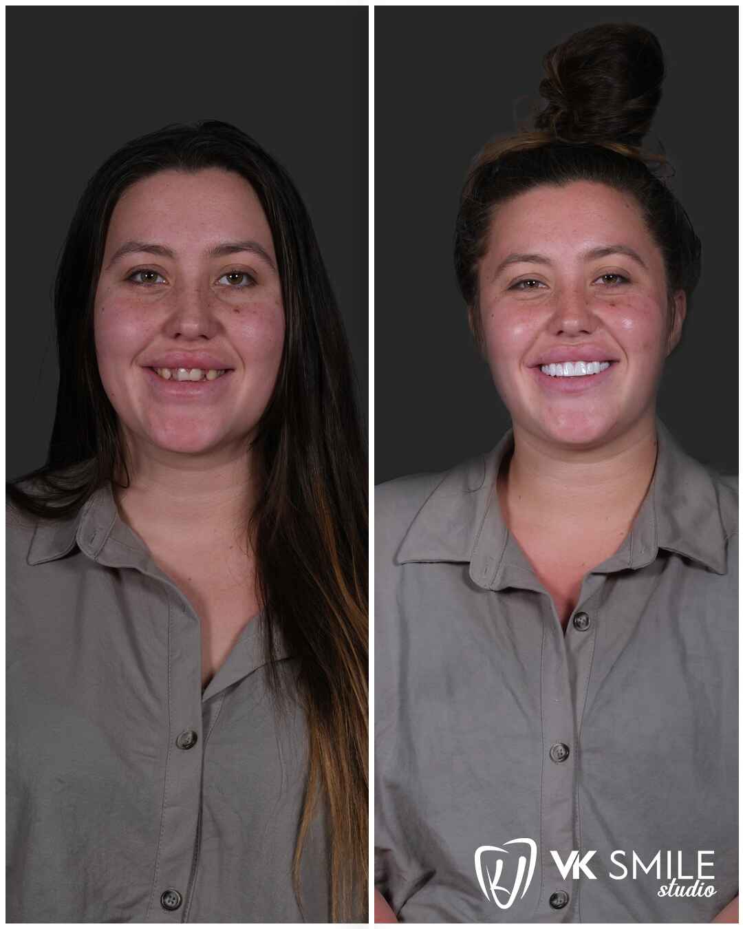 Before-After-VK-Smile-Studio-26