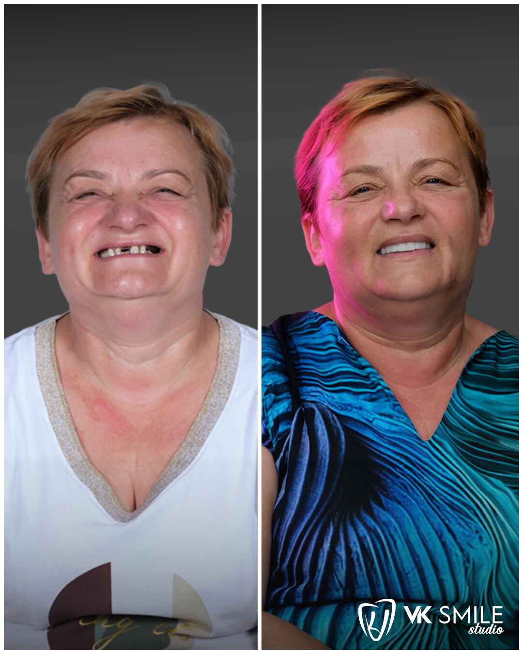 Before-After-VK-Smile-Studio-7