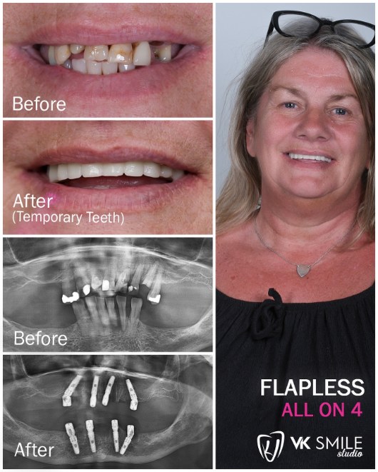 immediate-load-dental-implants