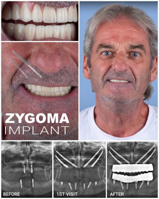 zygomatic-implants-1